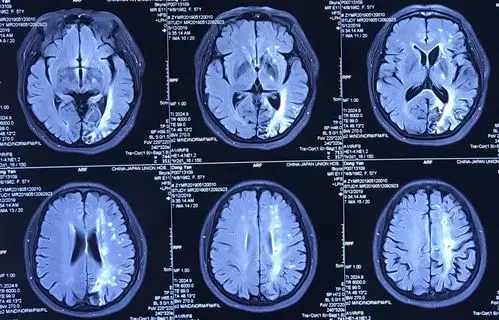 头部核磁平扫可见左侧大脑半球多发梗死灶,这就是患者反复缺血发作