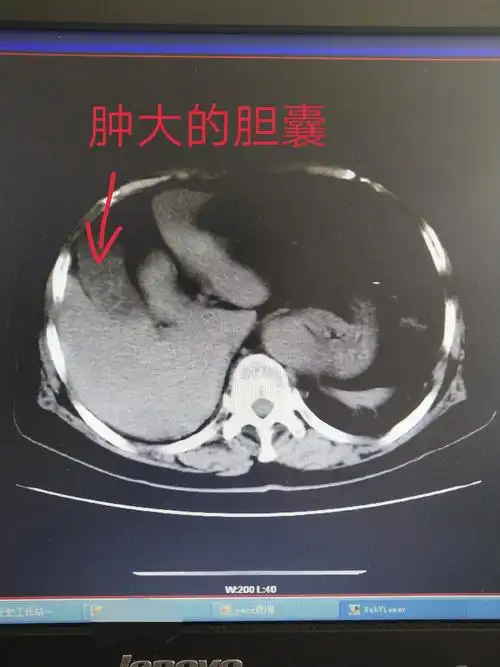 腹部ct提示:胆囊结石胆囊炎,右肾多发结石.