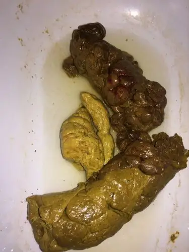 今天大便看到有鲜红色的血,用厕纸一碰大便 厕纸也沾上了红色.这是