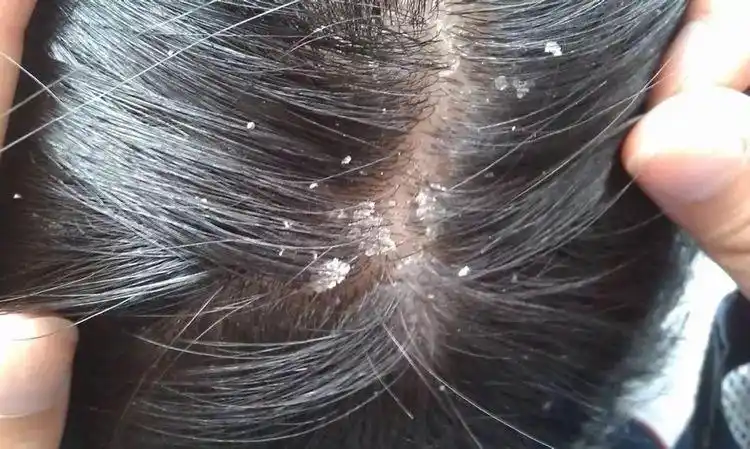 头皮常见的问题