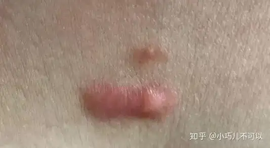 我女朋友胸前有个瘢痕疙瘩,有什么好的治疗方法吗? - 知乎