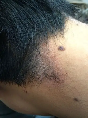 十岁孩子颈部后面皮肤不知道是什么皮肤病?