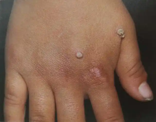 皮肤上这种小凸起,其实是病毒感染,小心越长越多|生殖器|丘疹|丝状疣