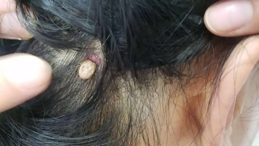 吉林医药学院附属465医院皮肤科 科普之八:蜱虫叮咬后的如何防治?