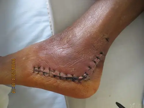 双跟骨粉碎性骨折术后这样能接受吗 [病例帖]