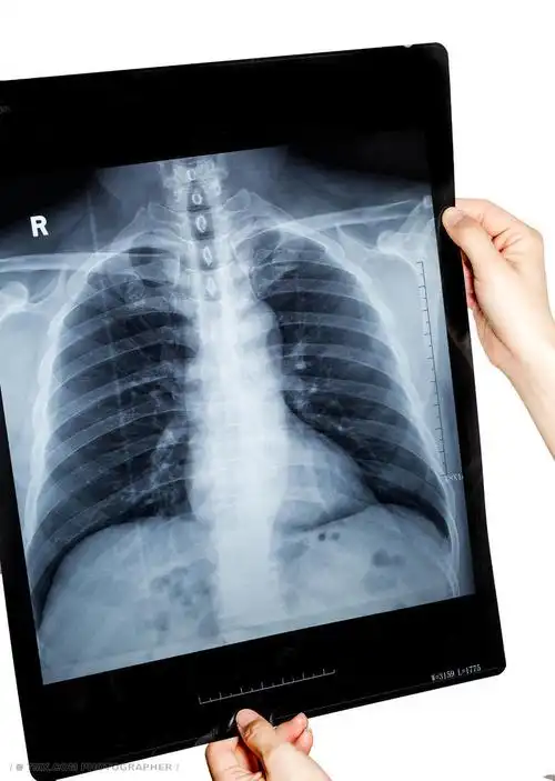 肺部ct图片 其他 健康 污染 保护 无人 射线 人类 医院 医生 科学