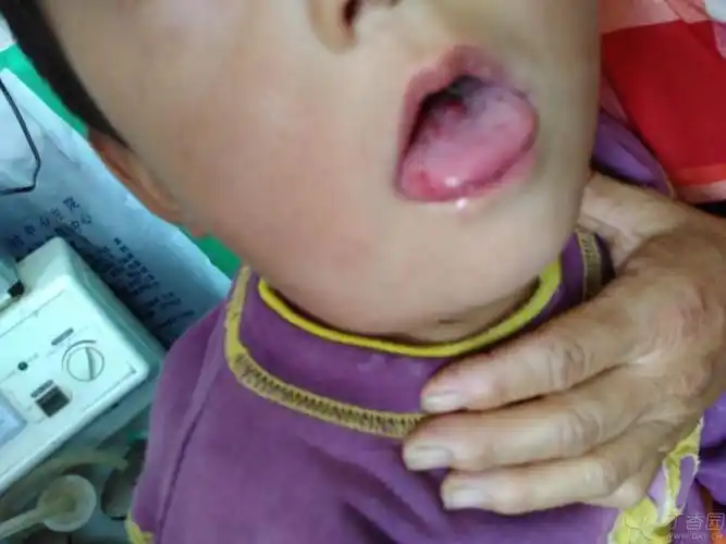 患儿 男 5岁 下颌反复肿大5年,加重1周,查体下颌淋巴结肿大,右侧颌下