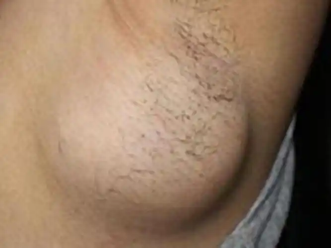 腋下淋巴结肿大高清图_有来医生