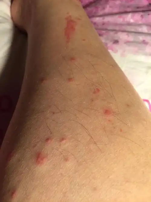 小腿处突然出了好多这样的疙瘩.一碰就特别痒,不碰的话不痒.