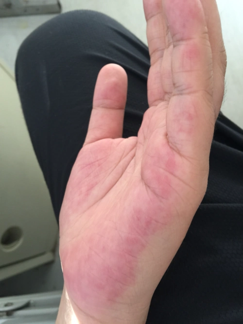 rt,19周2天了,最近手掌一直又红又热,百度了一下说是胎火旺,让喝绿豆