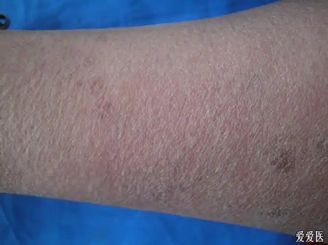 典型病例汗孔角化症