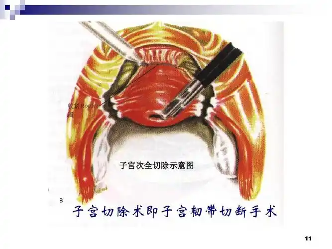 子宫次全切除示意图 子宫切除术即子宫韧带切断手术 11