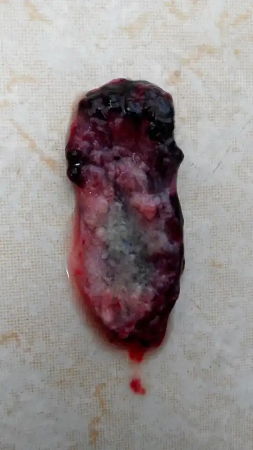 我自己在家吃了打胎药,流出来了一个东西,不知道这个是不是孕囊?