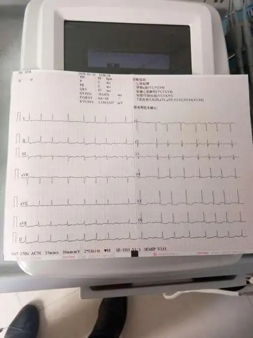 请问这份心律不齐? - 心电图脑电图专业讨论版 - 爱爱医医学论坛