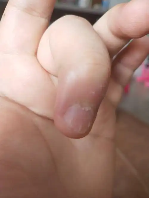 我的左手中指 指甲开裂这是什么情况啊