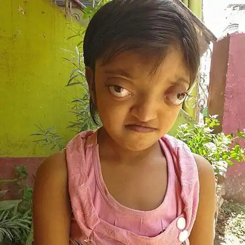 是什么原因导致的金鱼眼?