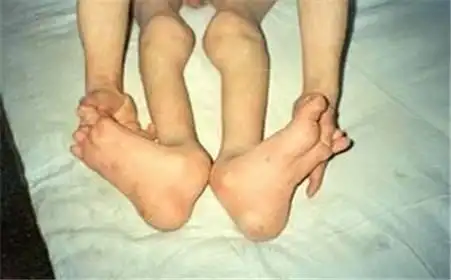 杜氏肌营养不良症治疗新药exondys51的临床试验显示疗效满意