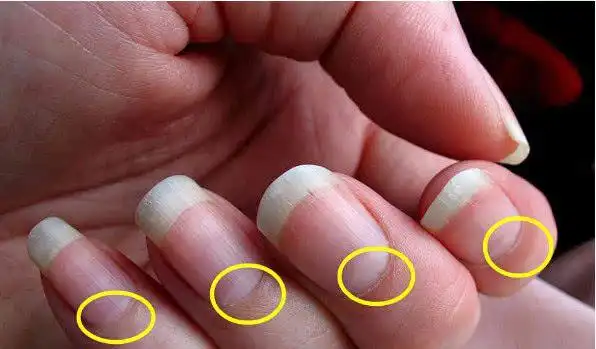 指甲出现3个异常暗示肾衰竭千万别拖到尿毒症晚期