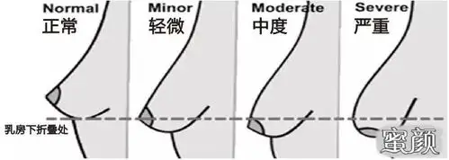 做完隆胸后手感好么?