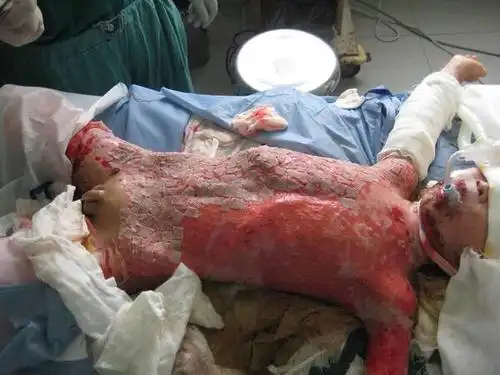 小儿大面积烧伤植皮手术前后比较1