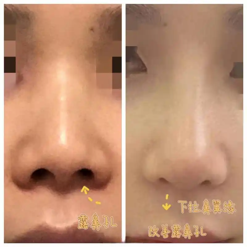 短鼻延长不是只把鼻尖延长,同时还要重视鼻翼的处理,不然鼻尖下来了