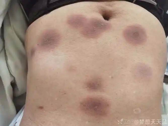 丁香园论坛>皮肤性病>帖子详情>