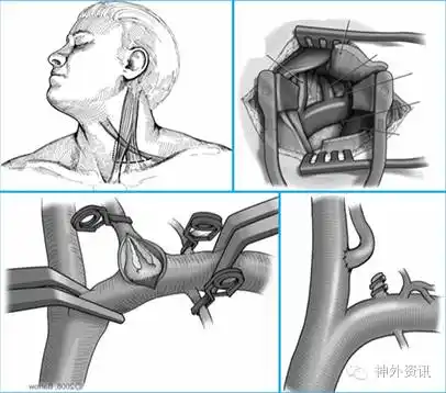 佟志勇教授:椎动脉内膜切除术--症状性椎动脉支架术后再狭窄,患者的"