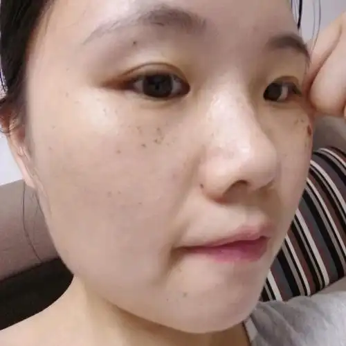 激光祛斑第五天,有两个斑点的结痂被我不小心揉掉了01今天终于可以