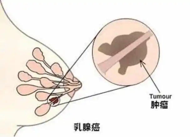 早期乳腺癌5大症状看看自己有没有中
