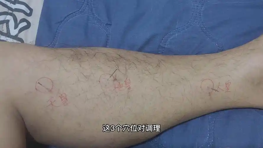 三皇穴治脾,肾问题,调节血糖