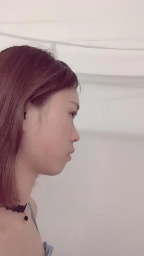 牙齿整齐但侧面嘴凸不知是骨性还是牙性呢