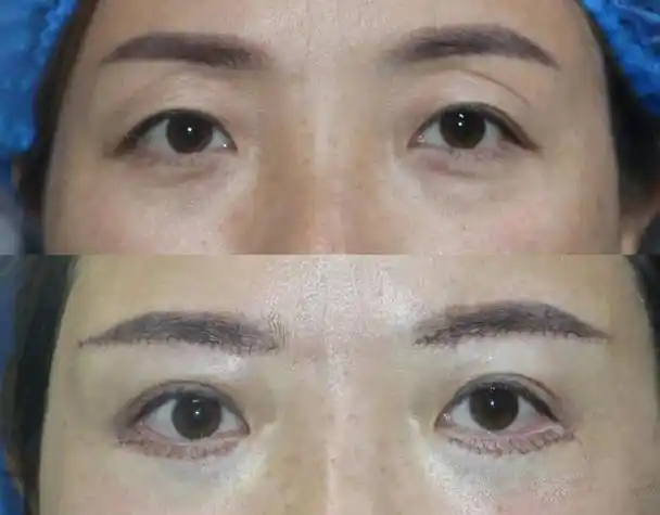 提眉术又称韩式悬眉,与切眉手术是不同的,提眉术是将眉毛及周围的皮肤