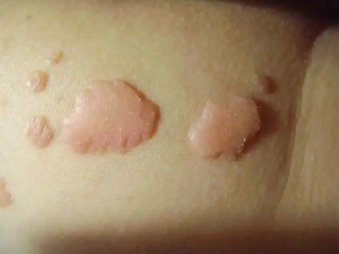 屁股上长的疣,前两年因为有了小孩子,没有去看,近