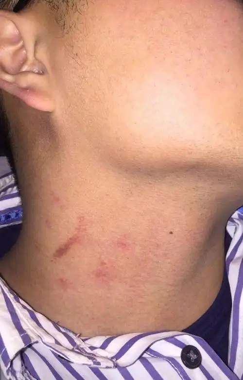 吻痕怎么弄 吻痕怎么弄好看点