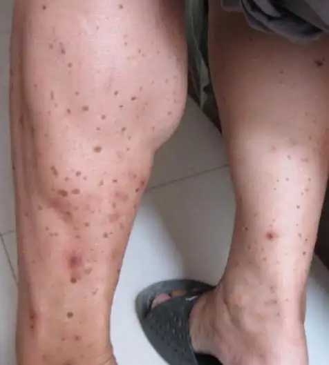 以下图片显示的,大腿上和手臂上长有黑斑,请给与正确性的建议,谢谢了5