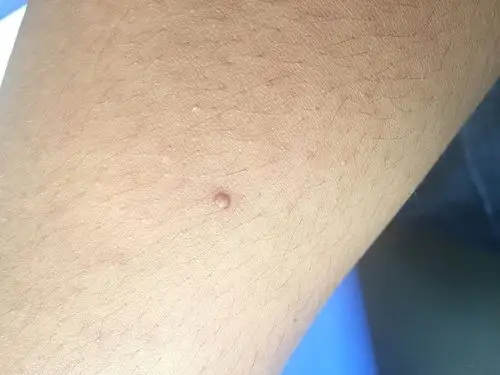 右胳膊上长了一个小凸起的物体两个月了不疼不痒麻烦医生