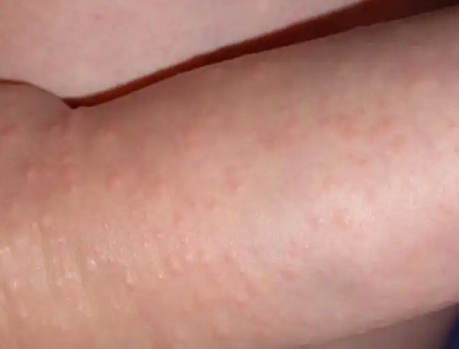 丘疹性肢端皮炎