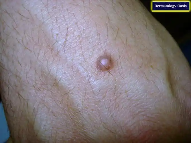 皮肤纤维瘤_介绍_发病原因_症状表现_治疗方式 - 好大夫在线