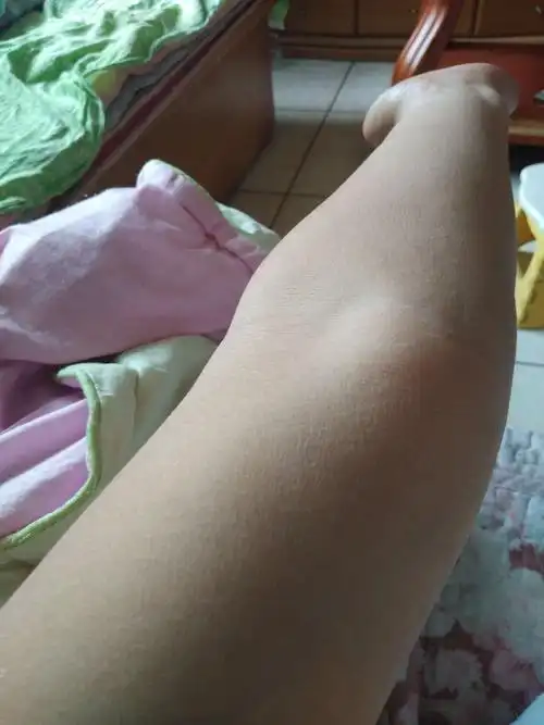 肘外翻怎么矫正