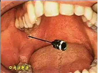 麻醉术口腔局部麻醉