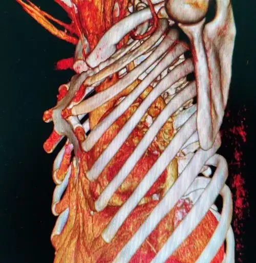 wenlin胸手术革命从改良wang手术到wenlin手术