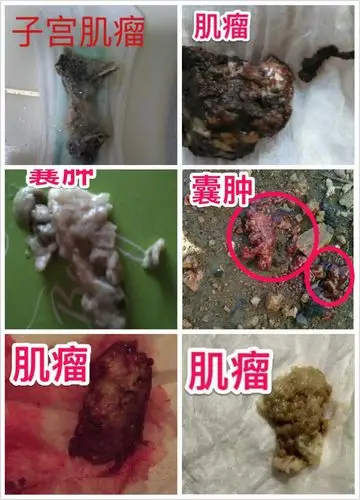 用棒女郎后的排出物对比图