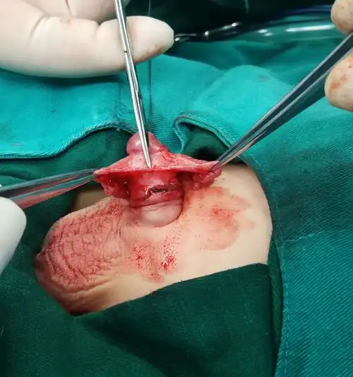 隐匿阴茎矫形术(f法)