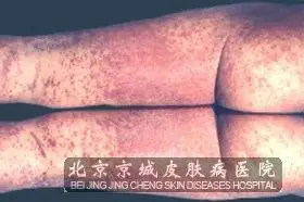 肛门部位湿疹有什么症状_湿疹_北京京城皮肤病医院(北京医保定点机构)