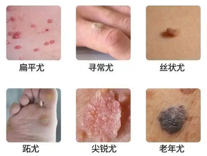 偏方治扁平疣瘊子跖疣尖锐湿疣的要点