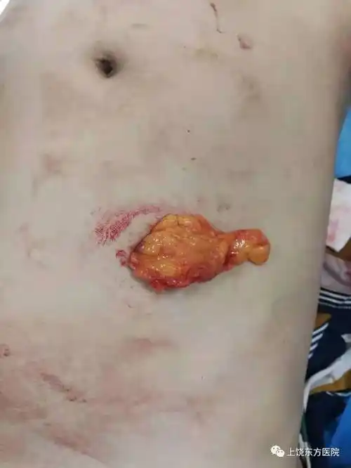 今日,上饶东方医院外科收治一名全身多处刀刺伤导致腹部,右臀部伤处