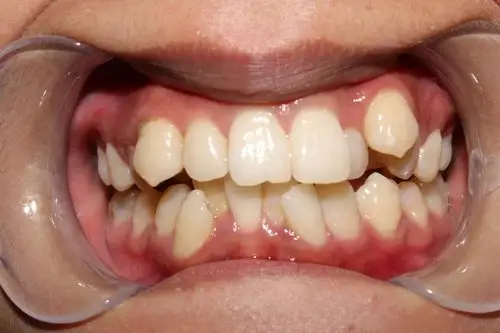 [cp]看照片你就知道拥有两排整齐的牙齿是多么重要