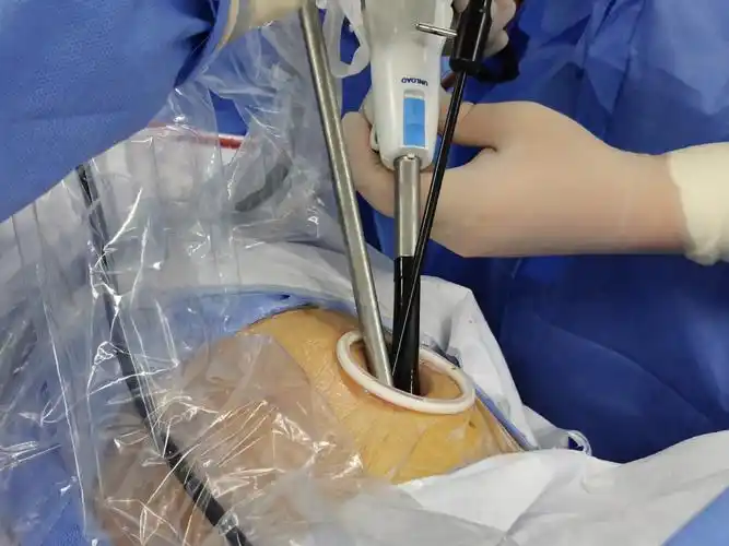 微创胸腔镜肺结节手术简介早期肺癌磨玻璃结节肺结节手术过程介绍