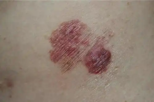 老人拇指上长了一块红斑,被子女"逼着"去看病,结果查出是皮肤癌