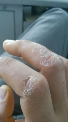 湿疹手癣症状图片_有来医生